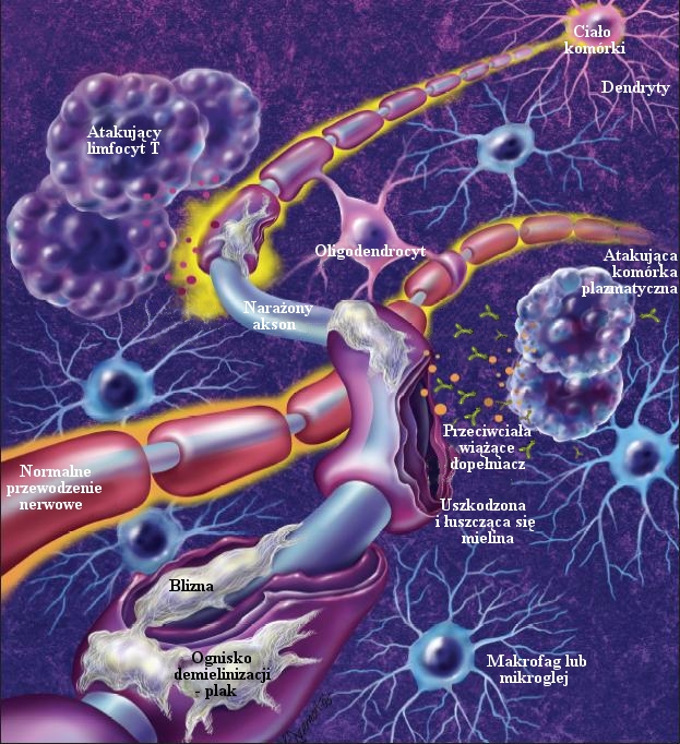 Komórki układu odpornościowego biorące udział w demielinizacji komórek nerwowych